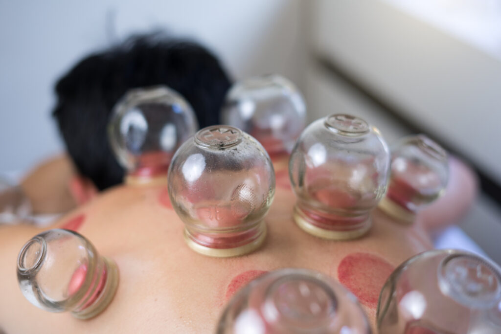 man in cupping therapy